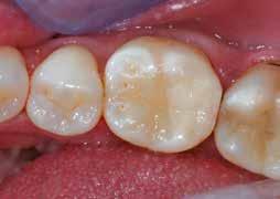 5, B1, B2, B3, C4 EQUIA Forte voegt een grote waarde toe aan mijn praktijk bij het behandelen van diepe cariëslaesies en het behoud van de vitaliteit van tanden.