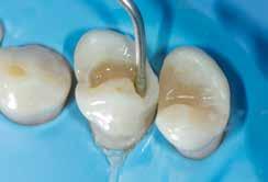 5, A4, B1, B2, CV (Cervicaal), CVD (Cervicaal donker) Opake (ondoorzichtige) kleuren: AO1, AO2, AO3 Glazuur (enamel) kleuren: JE (Junior),