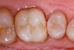 elasticiteit en taaiheid van dentine en de unieke spanningsbrekende eigenschap van DEJ te leveren." Dr.