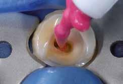 natuurlijke verdeling van de spanning in de tandstructuur Veilige hechting dankzij een combinatie van duale uitharding en contactuitharding Kleurengamma Een