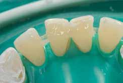 Geavanceerde structuren van wortelkanaalstiften en voorgevormde stompen Spalken van mobiele en getraumatiseerde tanden Orthodontische