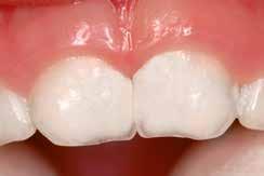 Fuji II LC hecht ook optimaal aan dentine zelfs als het sclerotisch is waardoor het een goede keuze is voor klasse V-restauraties, vooral indien die worden veroorzaakt door slijtage. Dr.