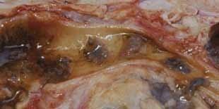 Acute infectie: Trektocht van duizenden jonge slakjes door lever geeft