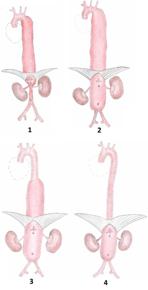 Thoraco-abdominaal aneurysma; dit aneurysma is zo groot dat ze doorlopen van de aorta in de borstholte tot en met de buikholte.