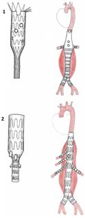 Figuur 4. Aorta stent Deze stents overbruggen het aneurysma tot in het gezonde bloedvat zodat er geen bloed meer in het aneurysma komt en zo de kans op een ruptuur wordt weggenomen.