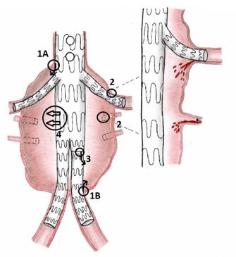 Ook de slagaderen van de lever, milt, maag en darmen worden voorzien van een eigen stent die in verbinding staat met de hoofdstent.