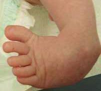 Afbeelding 1: Een klompvoet OORZAKEN KLOMPVOETJES De klompvoet is een aangeboren voetaandoening en komt bij ongeveer 1 op de 800 pasgeborenen voor.