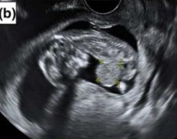 Detectie prenataal 96% * IUGR, premature partus Omphalocele PND Zwangerschapsuitkomst: 36% LB, 4% FD, 60% TOPFA # Herhalingsrisico