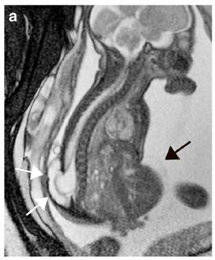 OEIS complex Omphalocele Exstrofie blaas en epispadie Imperforate anus (anus atresie) Spinale