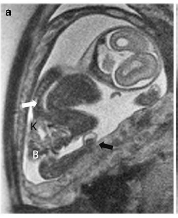 Buikwanddefect Neuraal buisdefect Ledemaat afwijkingen Scoliose Korte navelstreng