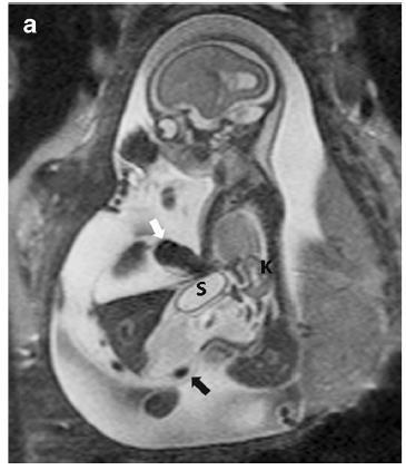 Pentalogie van Cantrell 1. Buikwanddefect 2. Hernia diafragmatica 3. Afwijkend borstbeen 4.