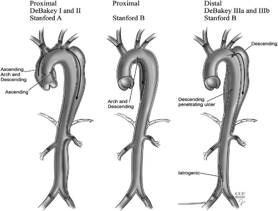 Aorta dissectie/geruptureerd aneurysma Prevalence of type A 52-67 % and type B 32-48 % In-hospital mortality in type A 30 % and in type B 13 % Tsai TT et al.