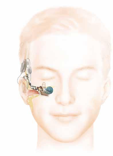 DIRECT AKOESTISCH COCHLEAIR IMPLANTAAT (DACI) Dit type implantaat kan gebruikt worden bij ernstig gemengd gehoorverlies, zoals bij heel ernstige otosclerose (middenoorverkalking), bij aangeboren