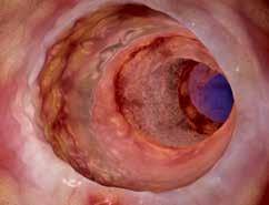 Darmontstekingen Ziekte van Crohn, 3D-illustratie Het prikkelbare darmsyndroom is een vaak voorkomende uitsluitingsdiagnose bij onduidelijke, langdurige en terugkerende darmklachten.