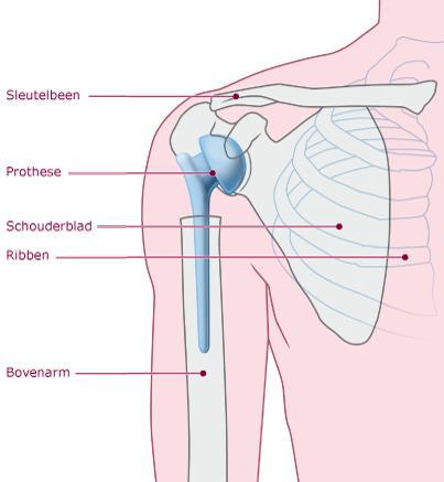 Men spreekt dan van slijtage (artrose), in de volksmond ook wel een versleten schoudergewricht genoemd.