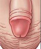 Na de operatie wordt de penis verbonden met een gaasje met vaseline of Betadinezalf. De operatie duurt ongeveer twintig minuten.