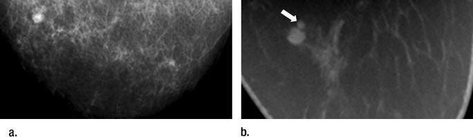 Figuur 4 Microcalcificaties op het mammogram zijn beter te detecteren (A, B) dan met de CBCT (C). (20) De score voor de zichtbaarheid is 7, wat een betere visualisatie betekent voor mammografie.