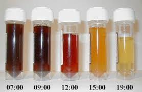 PNH: kliniek Mate van (intravasculaire) hemolyse is afhankelijk van: het % PNH cellen het type PNH (gedeeltelijke of volledige deficiëntie) Mate van complementactivatie Infectie: verhoogde