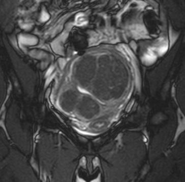 Leiomyoma Uterus degeneratie