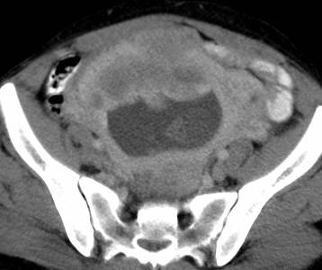 Uterus Myomatosus CT Vaak zelfde densiteit