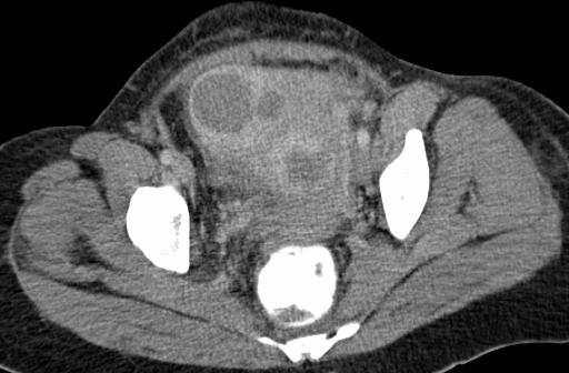 contourverandering uterus Postmenopauzaal