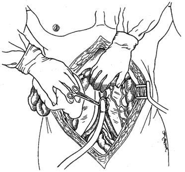 9.1. For the abdominal organs Three procurement techniques have been described: 1. super rapid technique 2. hypothermic in situ preservation with the double-balloon triple-lumen catheter 3.