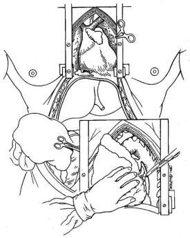This consists of a midline laparotomy followed by a rapid cannulation of the aorta to start the cold flush (figure 5).