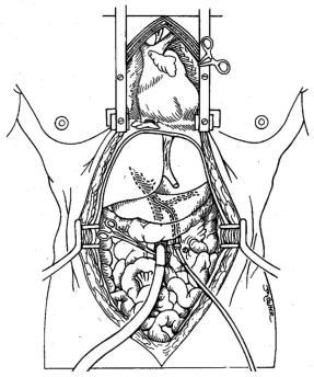 For the abdominal organs, venous venting can be easily achieved by opening the inferior caval vein in the pericardium.