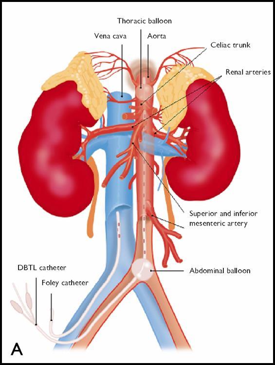 Foley catheter) is placed in the femoral vein allowing the outflow of the cold (4 C) preservation solution which is infused via the double-balloon triple-lumen catheter to cool the kidneys.