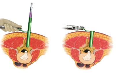 keuze van het soort operatie dat nodig is. De CT-scan kan dus tevens aanvullende informatie verstrekken bij een patiënt die eerder een MRI-onderzoek heeft ondergaan.