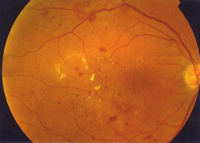 a b retinale bloedinkjes neovascularisaties macula harde exsudaten neovascularisaties retinale bloeding papil c Foto s van het rechter oog van een patiënt zonder visusklachten bij wie kort tevoren de