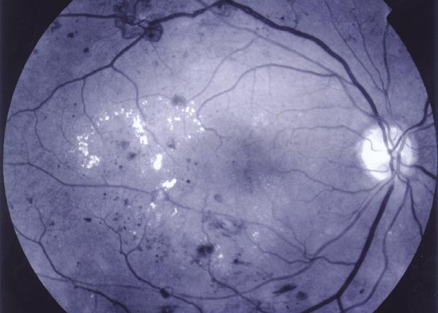 (c) fluorescentieangiogram. (figuur). Ten gevolge van ischemie ontstaan cotton wool spots (ook wel zachte exsudaten : witte, onscherp begrensde vlekken bestaande uit axonaal debris).