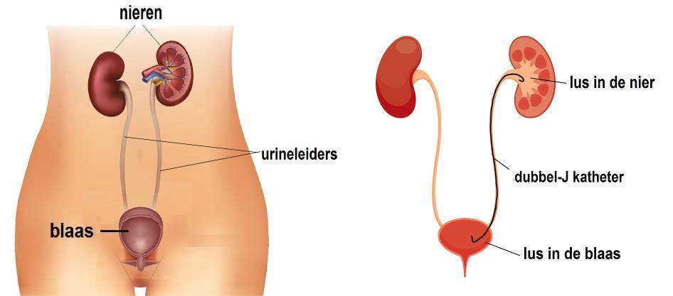 Om de urine toch af te voeren naar de blaas wordt een katheter ingebracht in uw urineleider. Deze katheter wordt een dubbel J katheter genoemd.