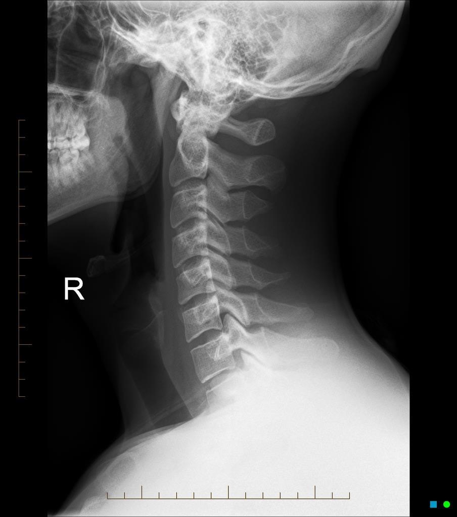 Spinaal casus 3 Man, 50 jaar, zéér hevige nekpijn sinds val met motorfiets 3 weken
