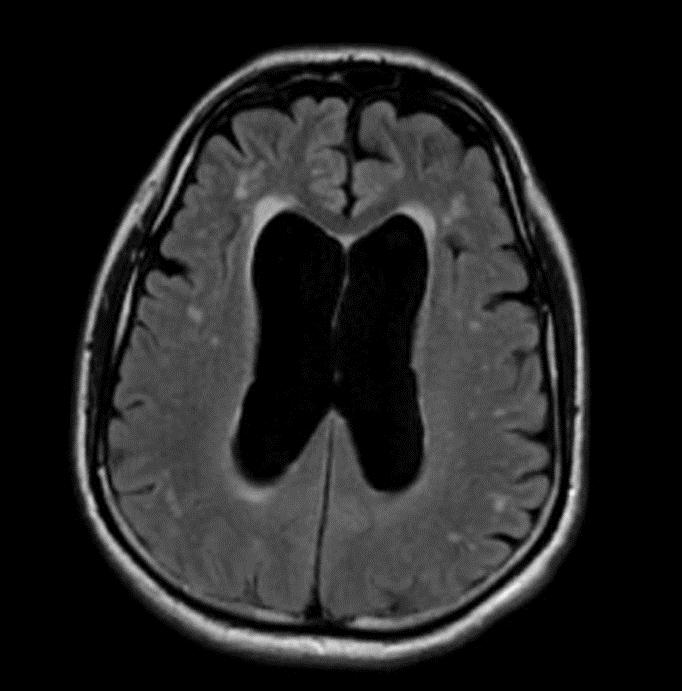 Craniaal casus 1 Man, 75 jaar, sinds paar maanden minder goed stappen, urinaire