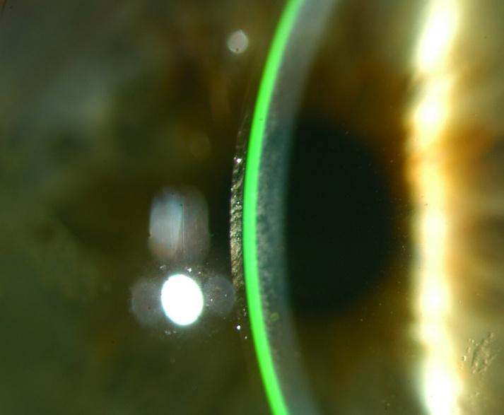 Optische sectie: De post lens traanfilm is ongeveer gelijk aan de lensdikte (200+µ). Dit is ideaal bij de eerste lensplaatsing. Er is te veel clearance na conjunctiva-compressie.