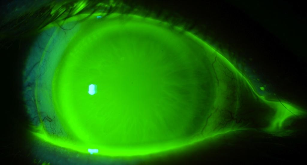 In de meeste gevallen is de gesuggereerde basiscurveradius van de diagnostische lens de finale basiscurveradius voor de voorgeschreven lens voor het respectievelijke oog.