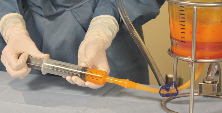 Om het vloeistofniveau te verlagen, verwijdert u de canule uit de patiënt en sluit u de bovenste klem op de Y-connectorslang (afb. 10).