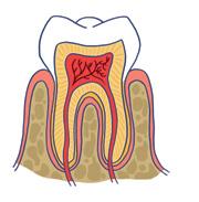 MONDPROBLEMEN Tandbederf (cariës) De zuren die geproduceerd worden door bacteriën in je mond kunnen heel wat schade aanrichten. Eerst raakt het tandglazuur aangetast.