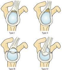 SLAP letsel: indeling Type 1: slijtage ( fraying ), LPB intact Type 2: labrum met LPB los