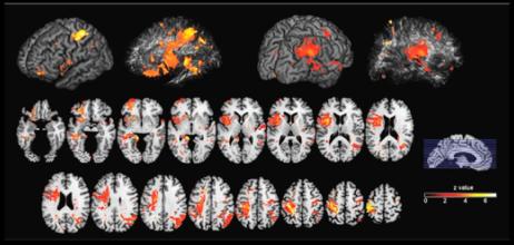 PFIT bij hersenbeschadiging PFIT bij hersenbeschadiging 241 neurologische patiënten met