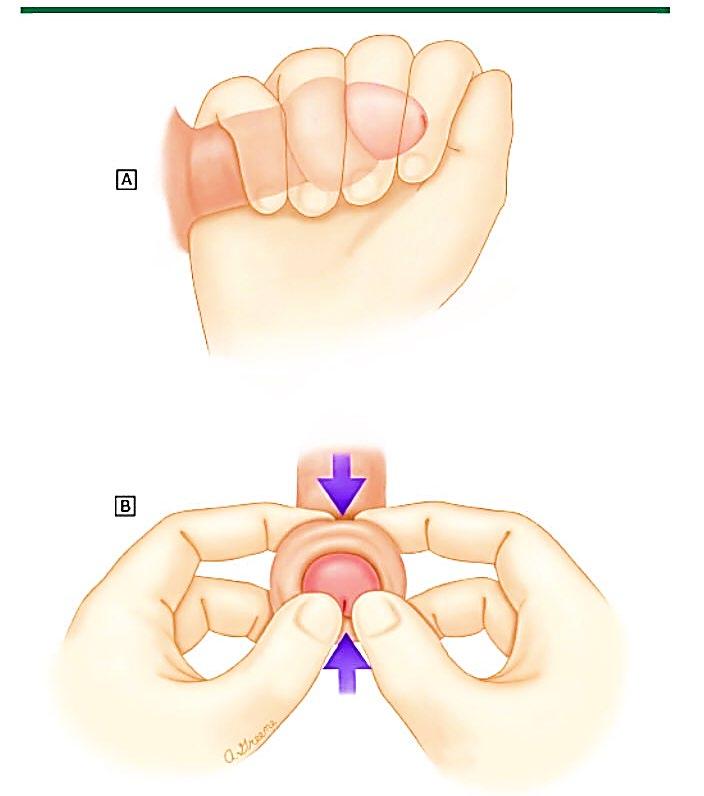 Manuele reductie van paraphimosis Ontzwellen: Druk uitoefenen op gedeelte