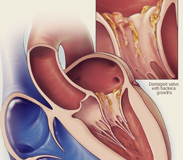 Infectieuze endocarditis: liefst te voorkomen, te genezen als het moett Huisartsensymposium Universitair Cardiologisch Netwerk Antwerpen (UCNA) Dr.