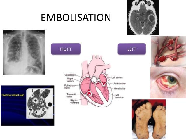 glomerulonephritis en