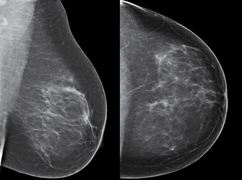 grootte en het feit dat BRCA1-tumoren meestal hooggradig zijn, was adjuvante chemotherapie geïndiceerd bij de behandeling.