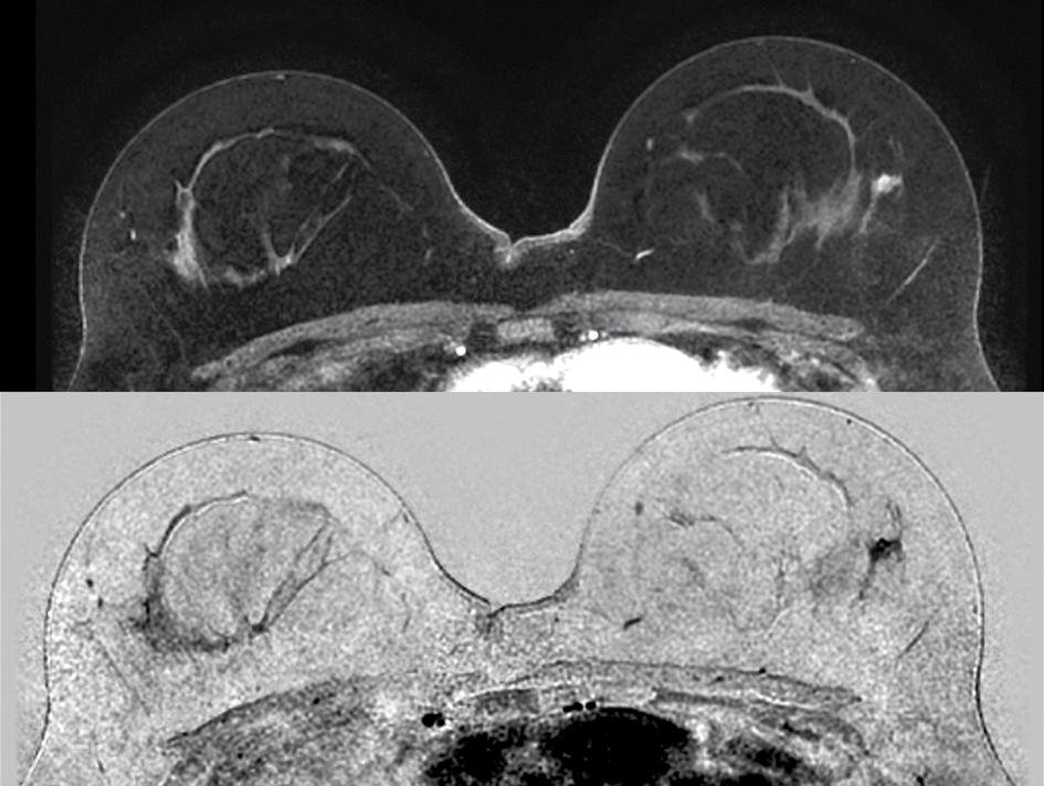 Besloten werd tot lumpectomie met een schildwachtklierprocedure, zodat patiënte tijdens de daarop volgende chemotherapie rustig de mogelijkheid van ablatio met reconstructie kon overwegen en ook kon