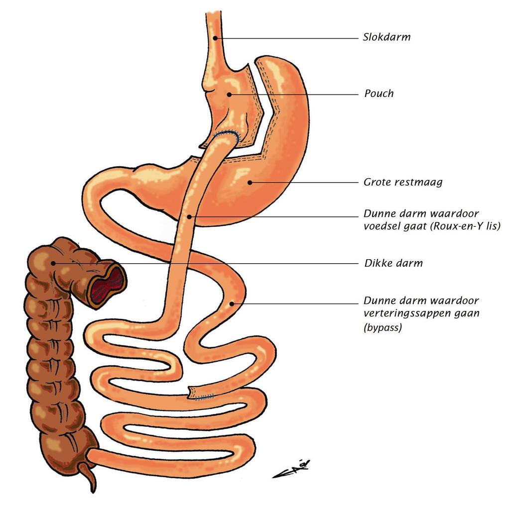 de Roux-en-Y gastric bypass (RYGB (zie figuur 3)) Deze restrictieve-malabsorptieve operatie wordt in Nederland het meest uitgevoerd.