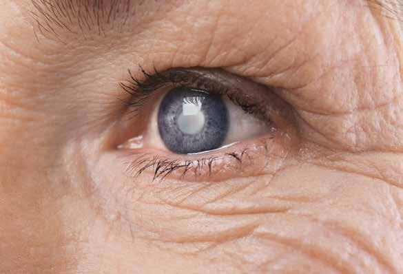 Wat is cataract? Cataract is een vertroebeling van de ooglens, meestal gebonden aan de leeftijd. Er bestaan verschillende vormen van cataract.