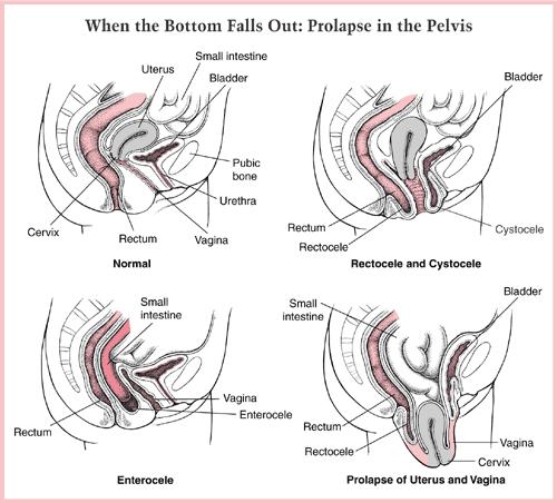 Combinaties van verschillende types van verzakking kunnen voorkomen: verzakking van de voorwand van de vagina verzakking van de blaas en/of urinebuis (urethra) verzakking van de achterwand
