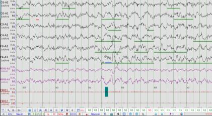 Polysomnography NIV ALS Methode Diagnostische PSG + 3 nachten titratie o PSG o Transcutane CO 2 meting en oximetrie o Geïntegreerde ventilator-software Nacht 1: diagnostische PSG Nacht 3: NIV met PSG